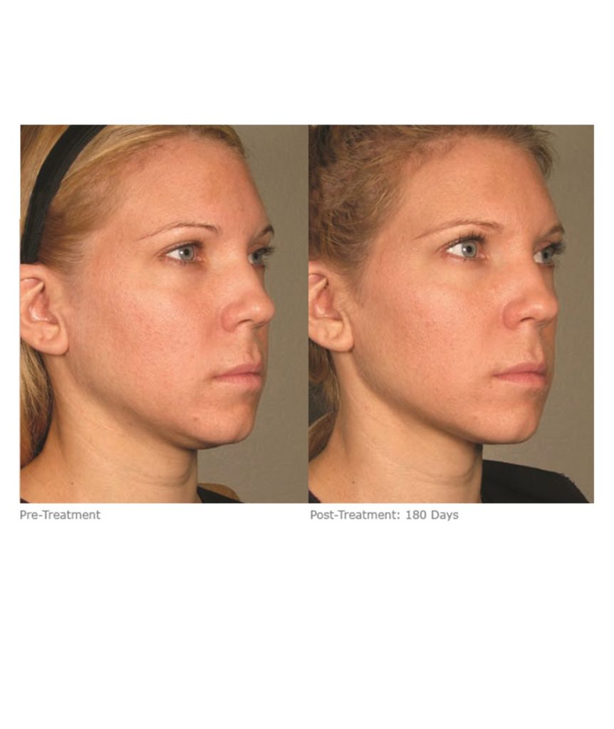 Ultherapy Skin Tightening By Skin Deep Midtown Med Spa